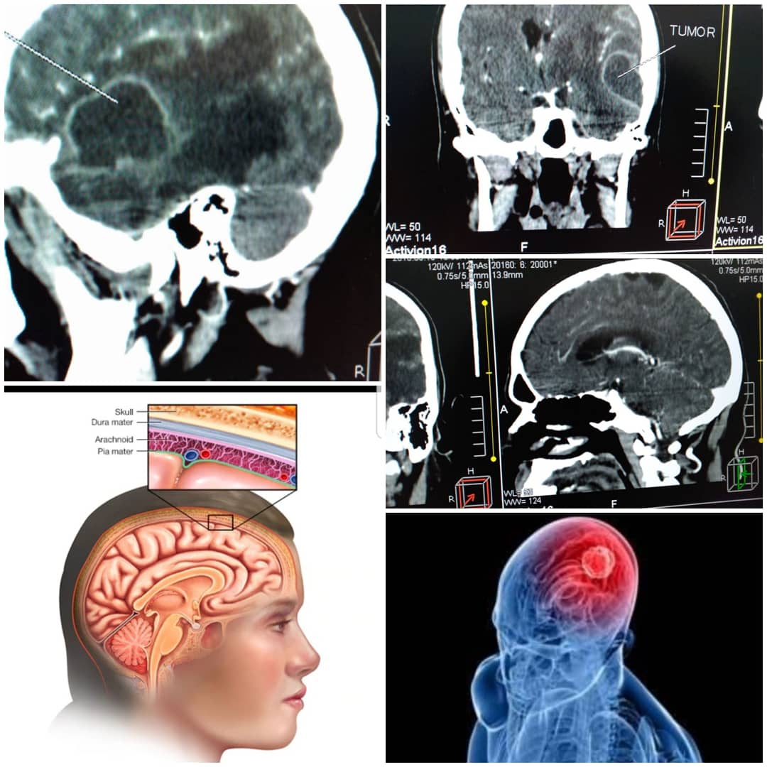 neurocirugia